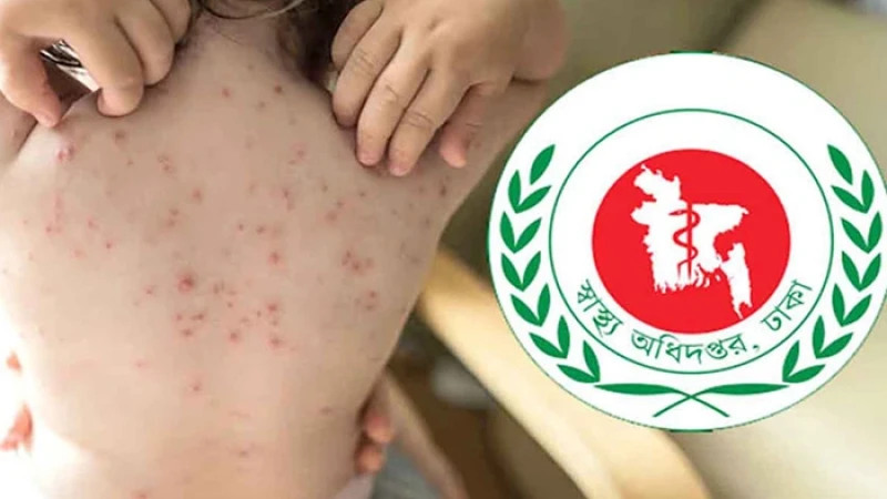 হাম : ২৪ ঘণ্টায় আরও ৬ শিশুর মৃত্যু, আক্রান্ত ১৪৪৫ জন
