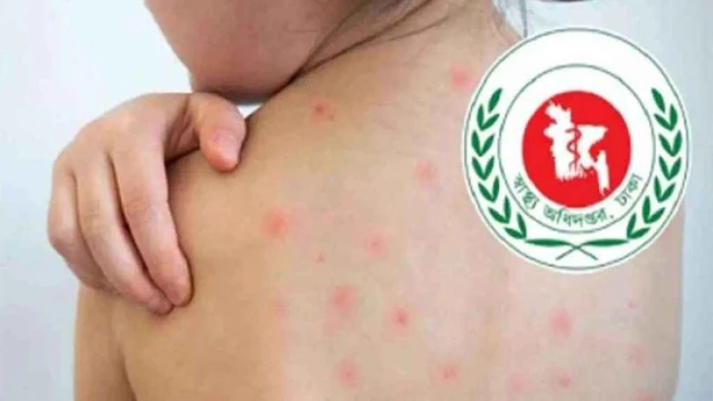 হামের উপসর্গ নিয়ে আরও ৫ শিশুর মৃত্যু