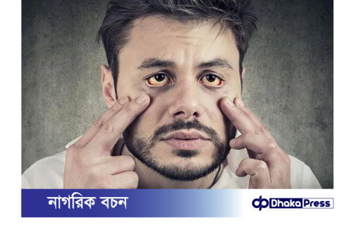 তীব্র গরমের বাড়ে জন্ডিসের উপসর্গ